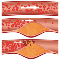 Atherosclerosis is a potentially serious condition